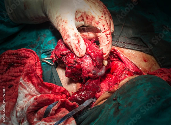 Obraz total thyroidectomy