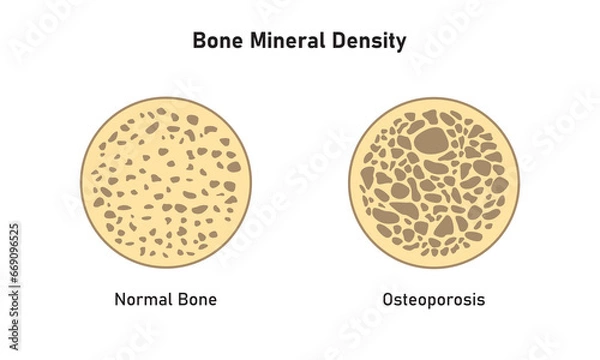 Obraz Osteoporosis (BMD) Concept Design. Vector Illustration.	