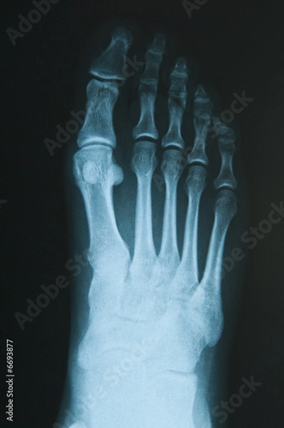 Fototapeta Radiografia del piede