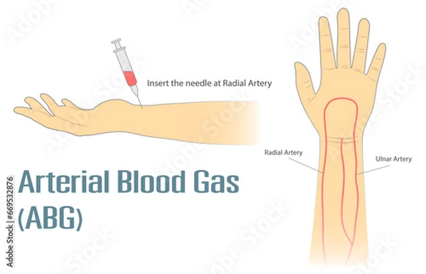 Fototapeta Arterial Blood Gas ABG test insert the needle at radial artery on wrist. Medical procedure vector isolated illustration on white background