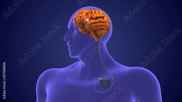 Obraz Deep brain stimulation medical concept	
