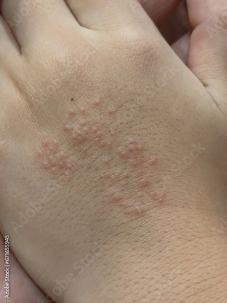 Obraz The rash is red and has small, clear blisters. On the skin on the back of the hand is caused by an allergy to certain chemicals.