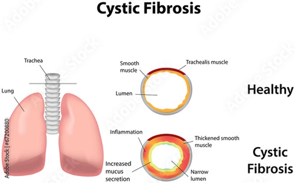 Fototapeta Cystic Fibrosis