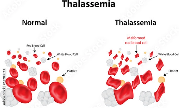 Fototapeta Talasemia