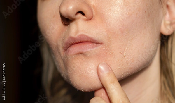 Fototapeta The woman skin flakes off at the mouth. Dry skin. Face skin irritation after peeling, after cold windy weather. Dark background, view by profile. She is showing the problem with the finger.