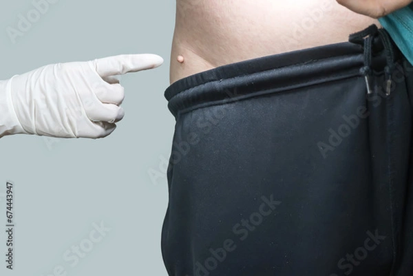 Fototapeta Skin tag or acrochondon or soft fibroma is a safe. It have not effect to the body. It usually occurs at neck, face, armpits and body.