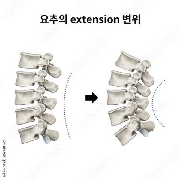 Obraz 척추 요추 신전변위