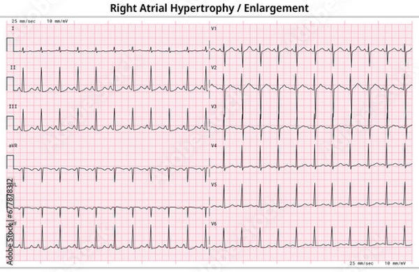 Fototapeta ECG Right Atrial Enlargement (RAE) - Right Atrial Hypertrophy (RAH) - 12 Lead ECG Common Case - 6 Sec/lead - Electrocardiogram Medical Vector Illustration