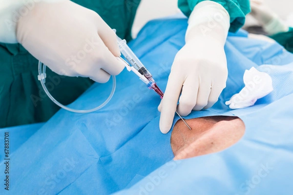 Obraz central venous pressure procedure