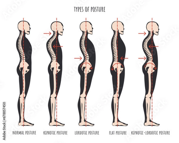 Fototapeta Type of posture, postural syndromes infographic. Skeletal samples of back problem kyphosis, lordosis and flat back. Normal posture medical educational poster. Vector illustration.