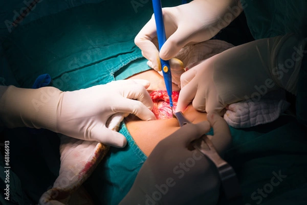 Obraz Rupture appendicitis s/p explore laparotomy to appendectomy