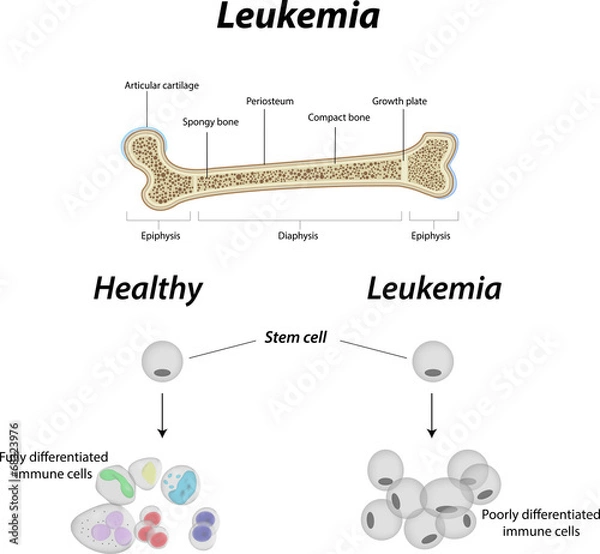 Fototapeta Leukemia Bone
