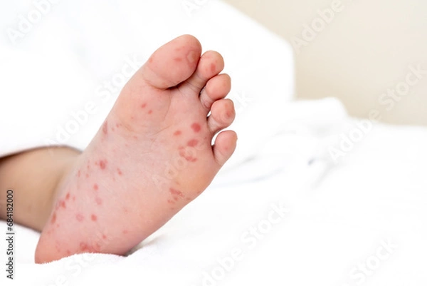 Fototapeta Enterovirus foot red spots blisters on the skin of on the body of a child virus on bed at hospital
