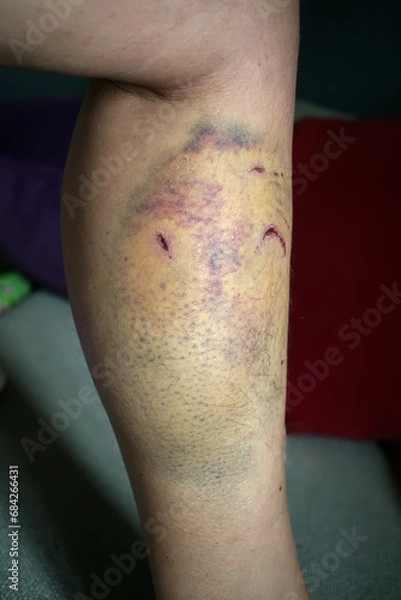 Obraz dog bite on leg with hematoma