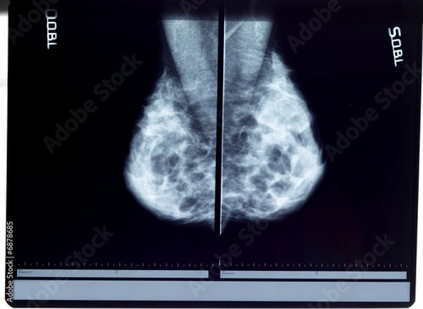 Obraz x-ray mammogram