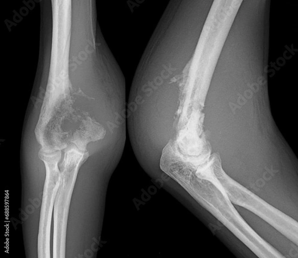 Obraz osteosarcoma  xray  elbow bone tumor 