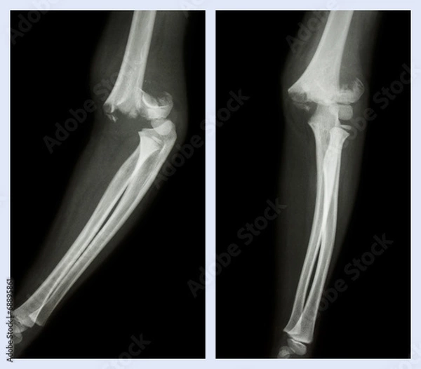 Fototapeta Fracture elbow