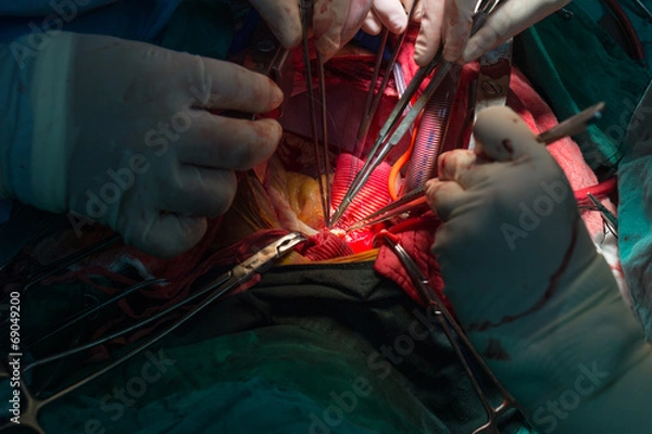 Obraz Bentall's operation in ascending aortic aneurysm