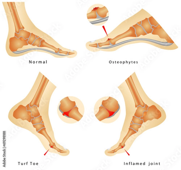 Fototapeta Turf Toe Injuries