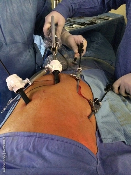 Fototapeta videolaparoscopia