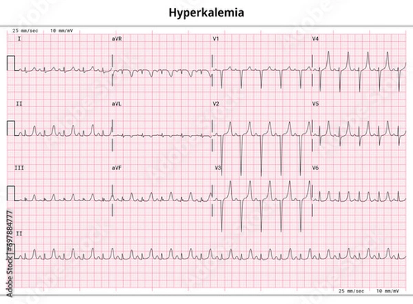 Fototapeta ECG Hyperkalemia - Hyperkalaemia - 12 Lead ECG Common Case - 3 Sec/lead - Vector Medical Illustration