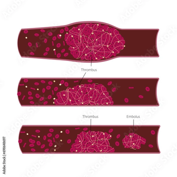 Fototapeta Different types of thrombus and embolus in the blood vessels closup illustration. Medical chart for science or education. Vector illustration