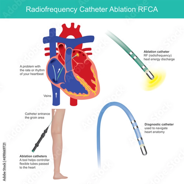 Fototapeta Radio frequency Catheter Ablation. Medical procedure is used to help control the heart rhythm problems such as atrial fibrillation..