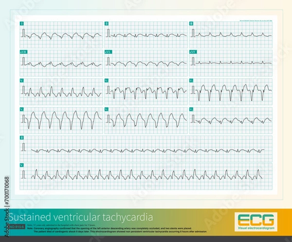 Fototapeta When ventricular premature contractions originate from the left ventricle, the QRS wave in lead V1 is often qR wave or notch R wave, which can be misdiagnosed as complete right bundle branch block.