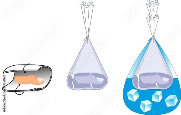 Obraz Erste Hilfe / Amputation