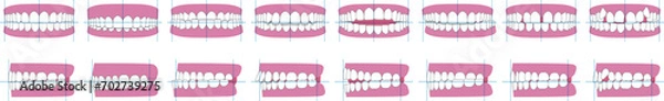 Obraz 歯並び、歯列の不正咬合の種類。正面と横のベクターイラスト