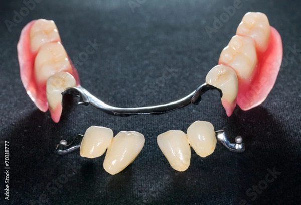 Obraz Removable dental prosthesis