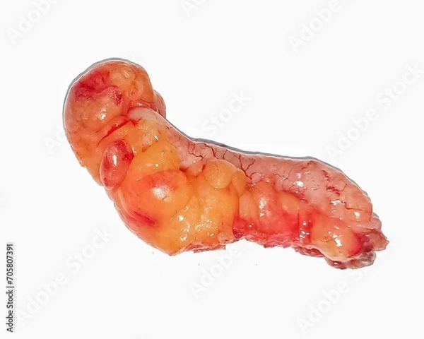 Fototapeta Appendix specimen from appendectomy, after surgery from the doctor.