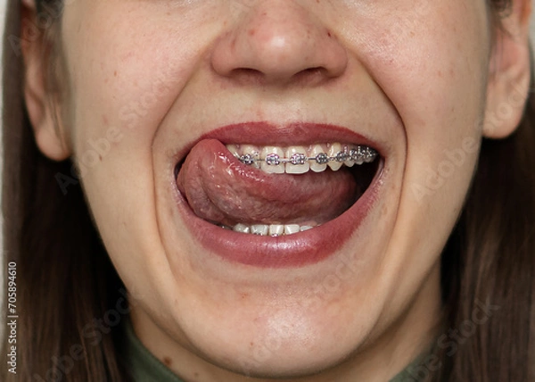 Obraz Metal braces on teeth. Close-up of a girl running her tongue over the braces on her teeth.
