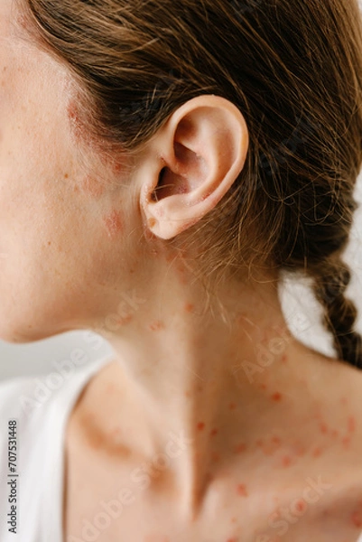 Fototapeta Close-up of the area of the body with affected skin diseases. Manifestations of red spots and scales of dermatitis, eczema, psoriasis on the hairline and scalp.
