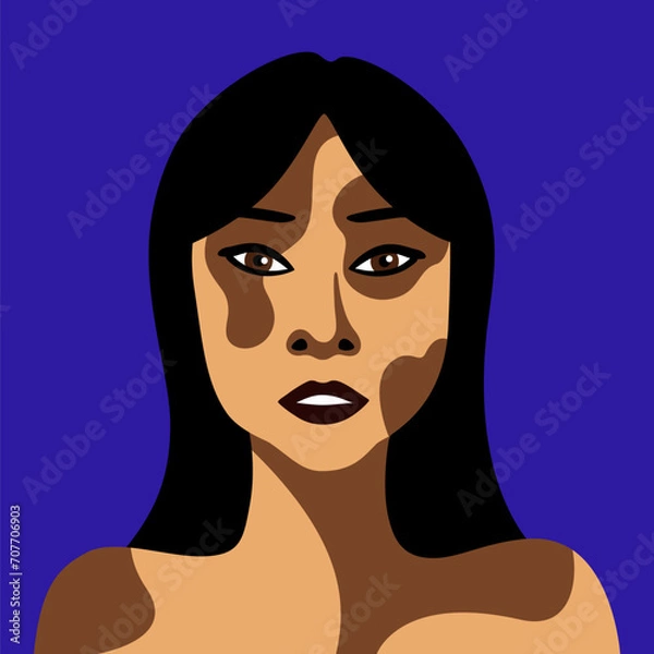 Obraz Young woman with Asian appearance with skin disease vitiligo in minimalistic style smiling