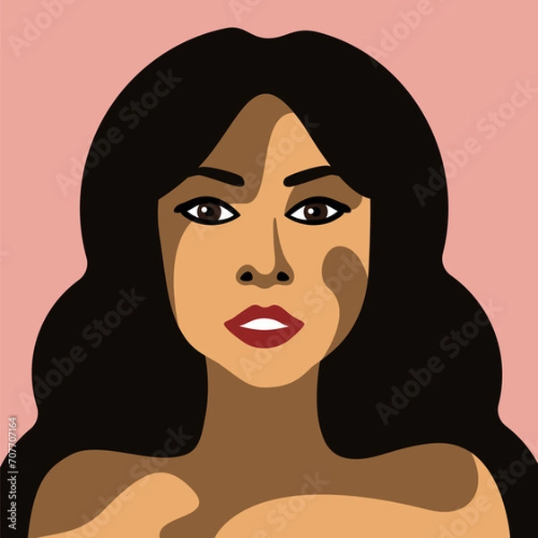 Obraz Beautiful young woman with vitiligo skin disease vector image in minimalistic style with brown eyes