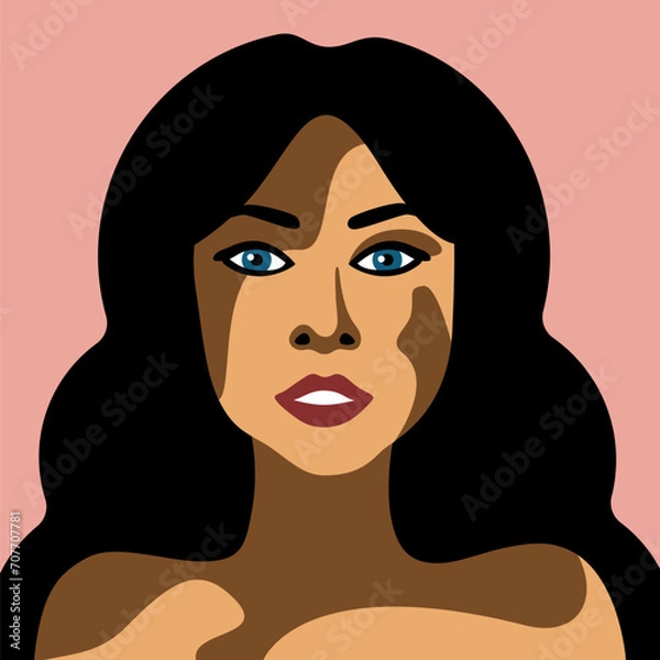 Obraz Beautiful young woman with skin disease vitiligo vector image in minimalistic style brunette