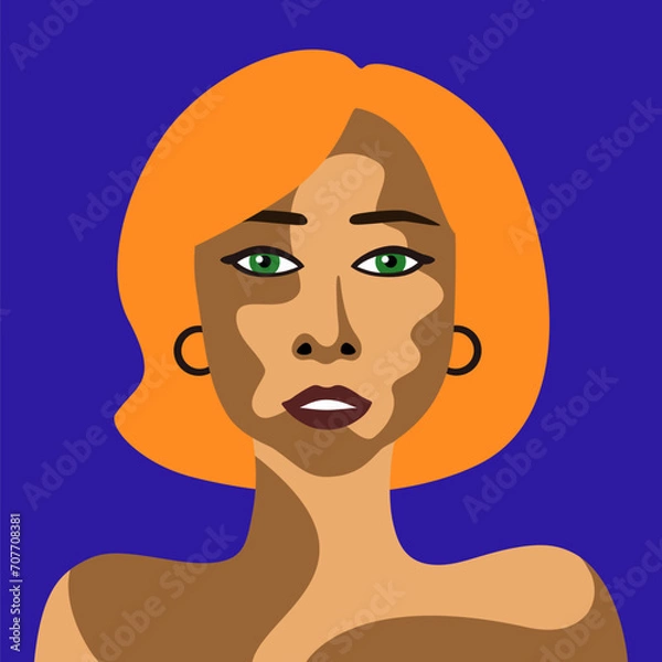 Obraz Red-haired young woman with skin disease vitiligo vector image in minimalistic style
