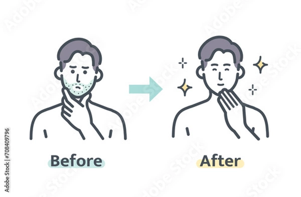 Obraz ヒゲ脱毛のビフォーアフター