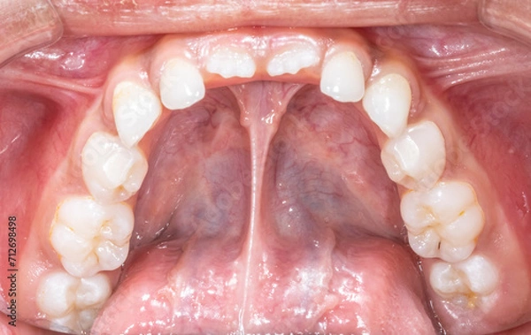 Fototapeta Lower mandibular arch occlusal indirect mirror view of a child milky dentition and permanent incisors erupting, teeth aligned and no decay. Gingival gum, tongue lifted with lingual frenulum.