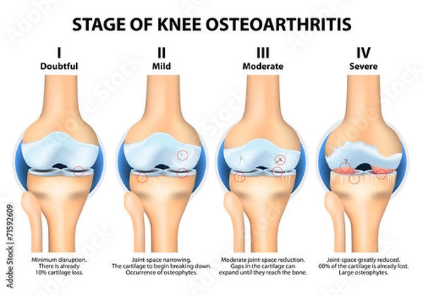 Fototapeta Etapy choroby zwyrodnieniowej stawu kolanowego (OA).