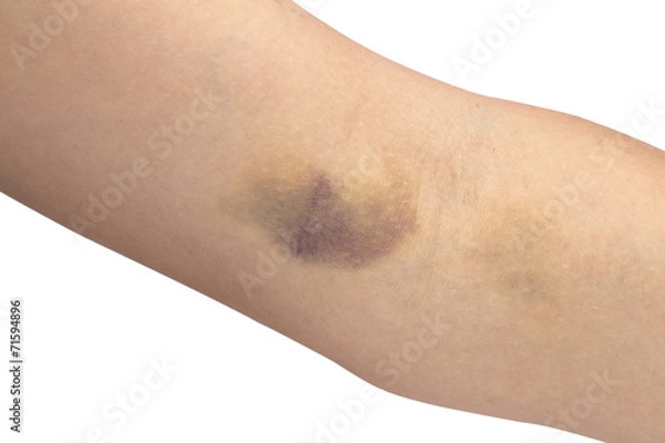 Obraz bruise on the white background