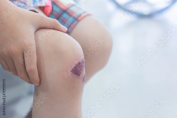Fototapeta Close up with copy space of fresh wound with red blood on knee of little kid girl who just falling down in accidental injury shows concept of injury for childhood suffering pain and hurt.