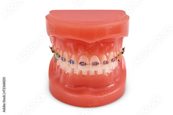 Obraz braces model