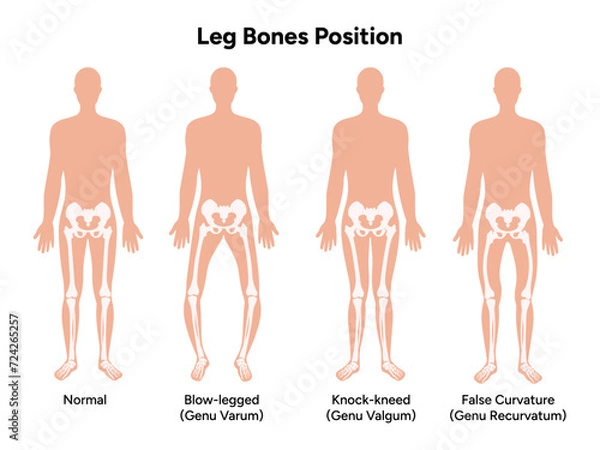 Obraz Leg bones position Blowlegged knock-kneed face curvature