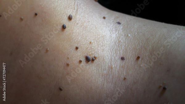 Fototapeta High-resolution close-up image showcasing skin tags, also known as acrochordon, on the neck of a woman, perfect for dermatology, healthcare, beauty, and medical concepts