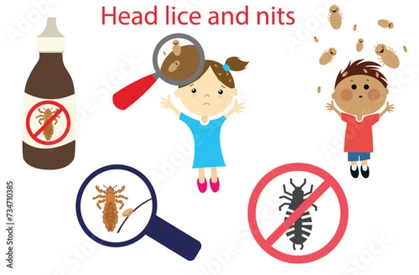 Fototapeta Head lice and nits,tiny insects that live in hair,the empty egg cases attached to hair,itchy scalp,child with lice,Boy,girl and child, girl with lice on her head. Vector illustration,Lice vectors