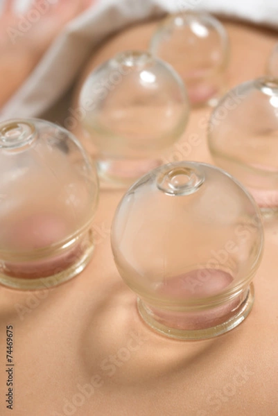 Fototapeta Schröpfen