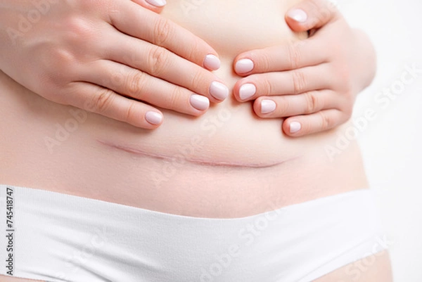Obraz Woman holding her belly and demonstrates hypertrophic scar after c section. 