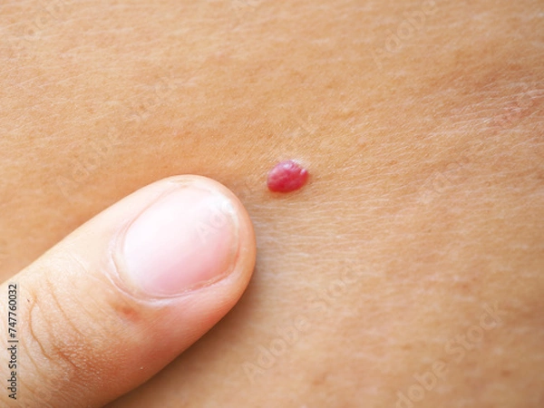 Obraz Man points a finger at a large mole on his back. Closeup photo, blurred.